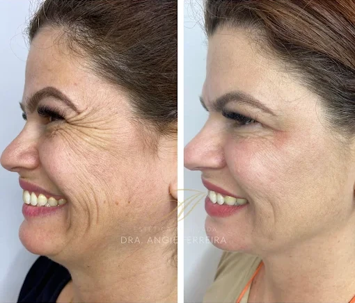 Toxiona_Botulinica_Botox_Dra_Angie_1