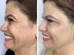 Toxiona_Botulinica_Botox_Dra_Angie_1
