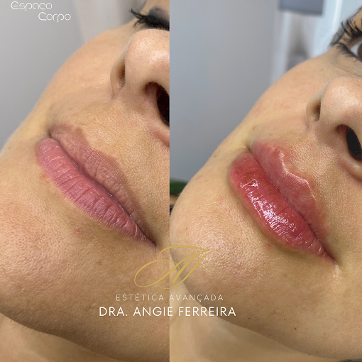 Preenchimento labial com ácido hialurônico realizado pela Dra. Angie Ferreira. na Clínica Espaço Corpo - Campinas.