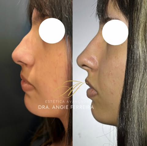 Antes e depois de paciente que fez rinomodelação com ácido hialurônico com a Dra. Angie Ferreira 